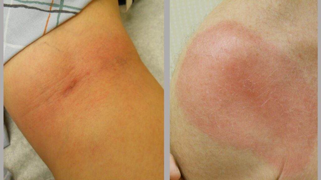 Two rashes on white skin.